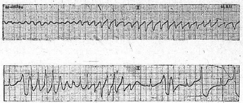 自动体外除颤器是什么自动体外除颤器AED_https://www.jmylbn.com_新闻资讯_第4张