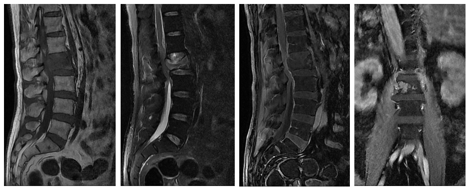 桡动脉鞘怎么读R.A.V.I.Club微课堂 · 经桡动脉外周介入之长征篇第八期_https://www.jmylbn.com_新闻资讯_第6张
