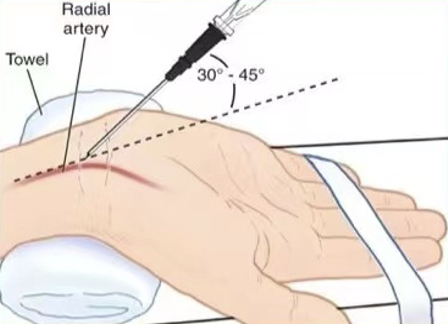 桡动脉鞘怎么读R.A.V.I.Club微课堂 · 经桡动脉外周介入之长征篇第八期_https://www.jmylbn.com_新闻资讯_第5张