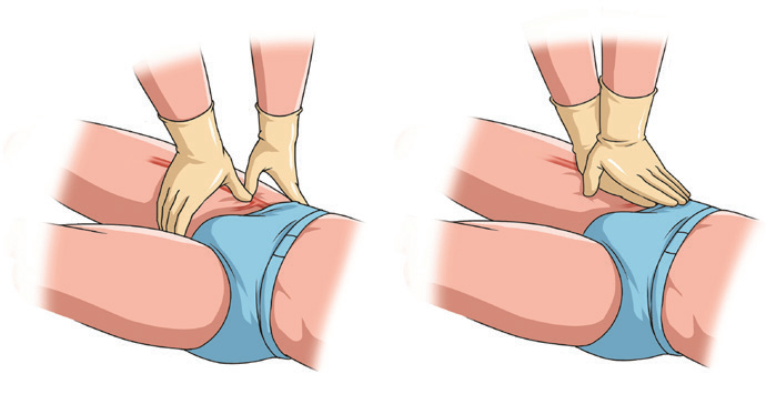 动脉什么压迫止血【健康科普】应对创伤，必学的止血法_https://www.jmylbn.com_新闻资讯_第7张