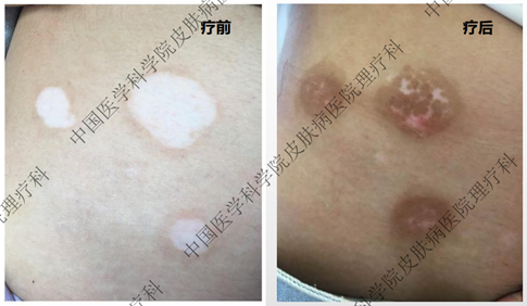 什么是光电治疗白癜风的光电传奇_https://www.jmylbn.com_新闻资讯_第9张