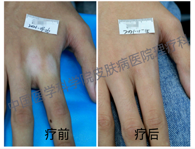 什么是光电治疗白癜风的光电传奇_https://www.jmylbn.com_新闻资讯_第10张