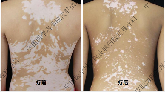 什么是光电治疗白癜风的光电传奇_https://www.jmylbn.com_新闻资讯_第7张