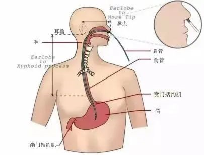 鼻饲胃管什么牌子的好聊聊“生命之管”-鼻胃管喂养_https://www.jmylbn.com_新闻资讯_第2张