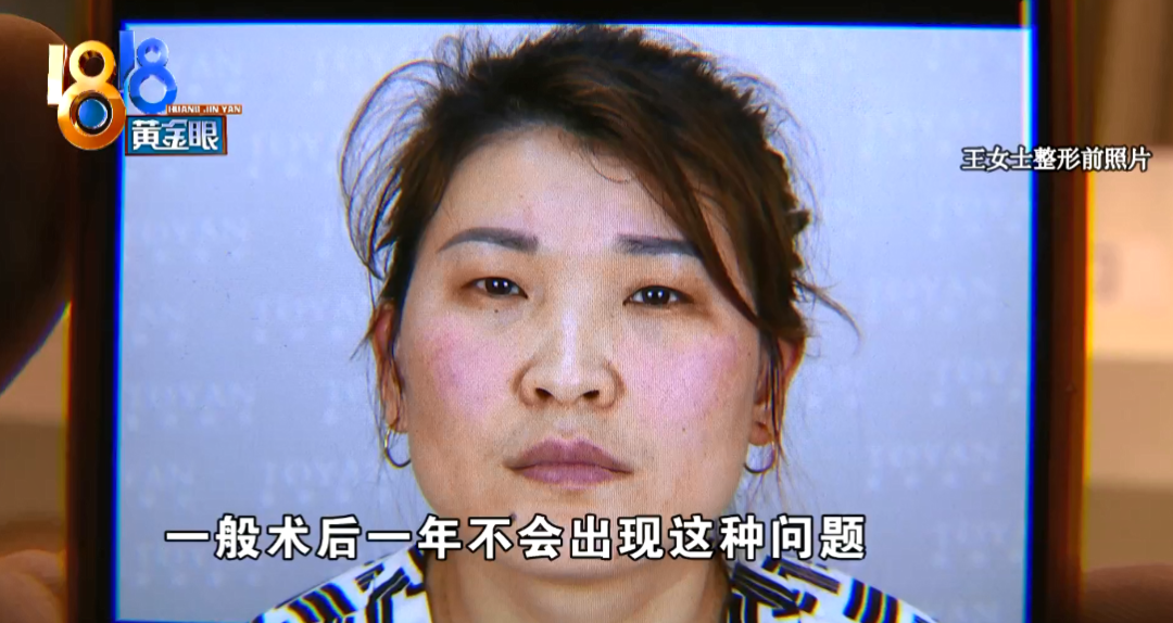 整形后 眼皮凸大腿凹 童颜医美 因为胖了 1818黄金眼 微信公众号文章阅读 Wemp
