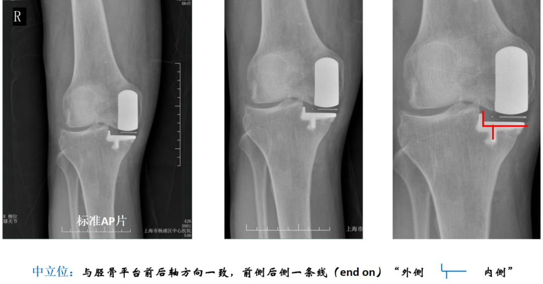 【读懂单髁】从读懂X-ray开始：胫骨假体位置解读