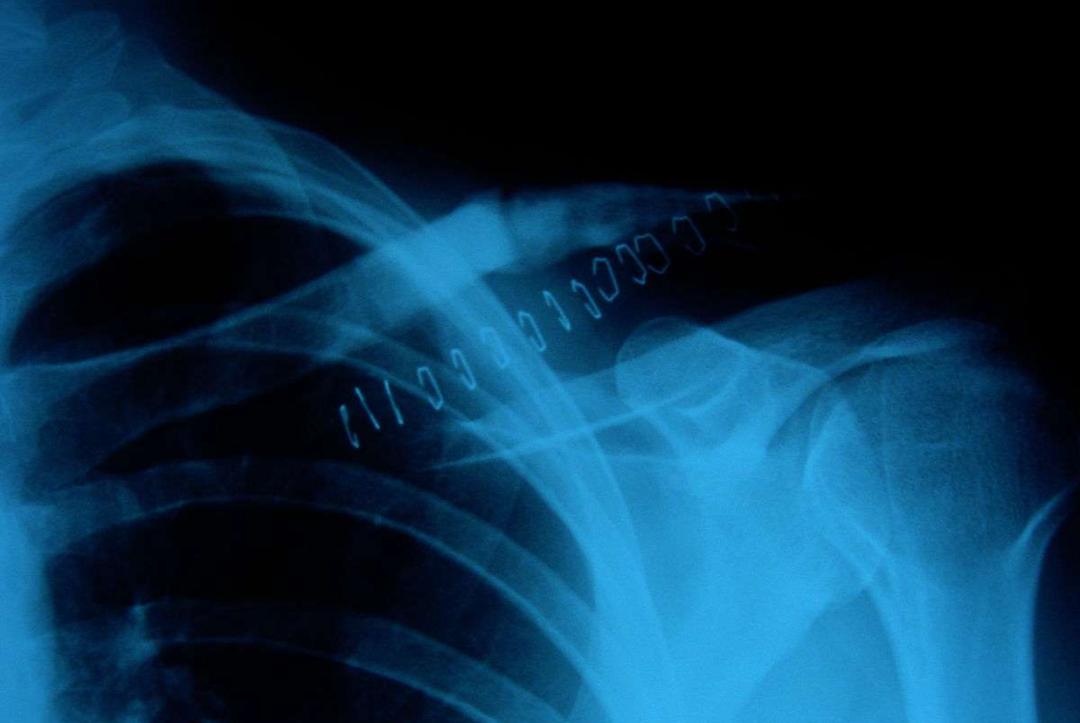 锁骨骨折：从分型到治疗的超全讲解，一文搞定！