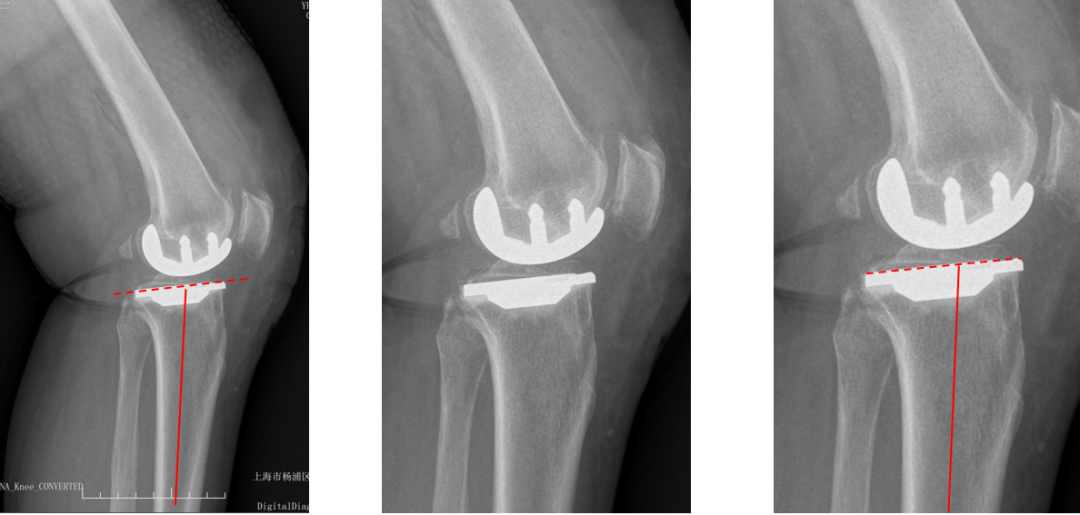 【读懂单髁】从读懂X-ray开始：固定平台单髁假体(SIGMA®