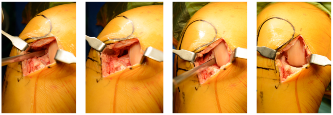 【滑动垫片单髁置换技术精讲系列】第一讲：麻醉、体位