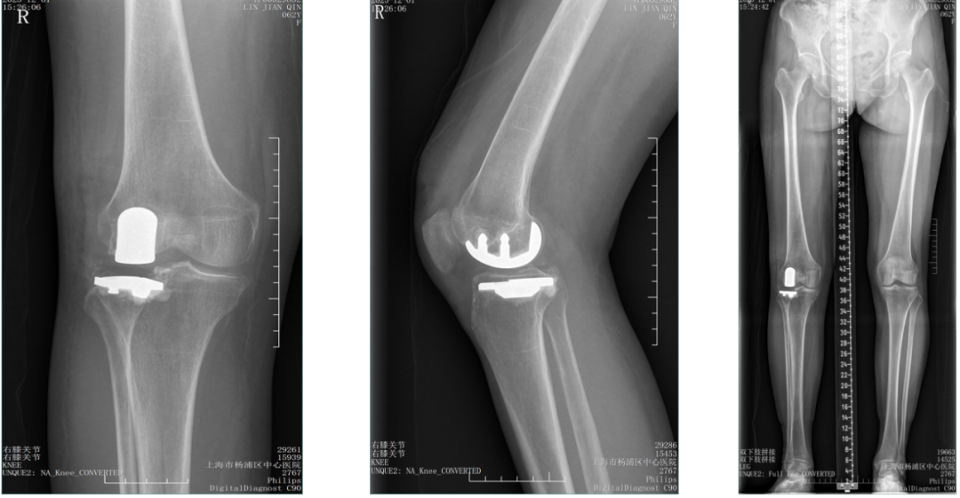 【读懂单髁】从读懂X-ray开始：固定平台单髁假体(SIGMA®