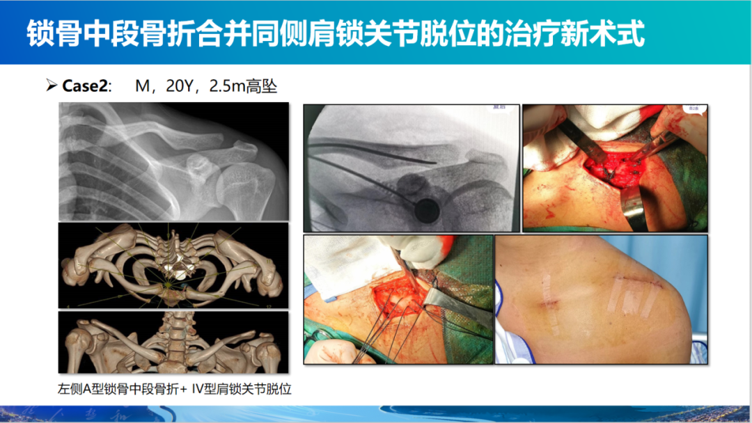 锁骨中段骨折合并同侧肩锁关节脱位新术式：弹性髓内钉+喙锁韧带重建、关节囊缝合