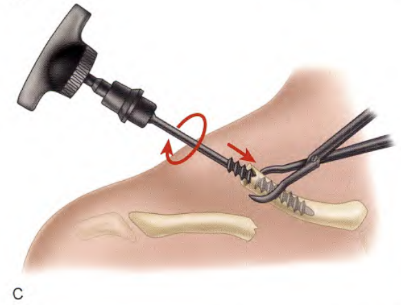 锁骨骨折：从分型到治疗的超全讲解，一文搞定！