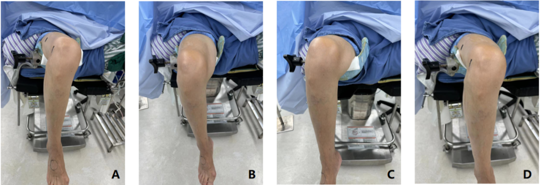 【滑动垫片单髁置换技术精讲系列】第一讲：麻醉、体位