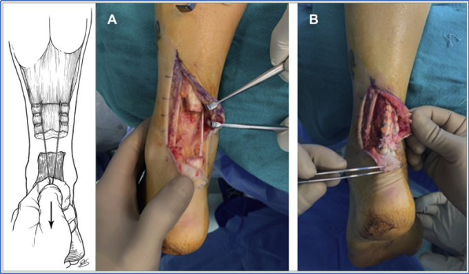 ​图文并茂：慢性跟腱断裂的最新治疗进展