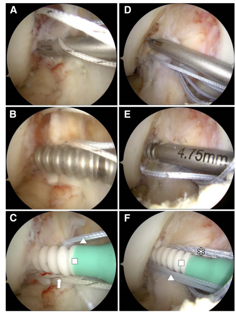 图文详解关节镜下如何实现对前交叉韧带近端撕裂的精准修复