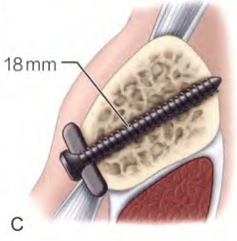 锁骨骨折：从分型到治疗的超全讲解，一文搞定！