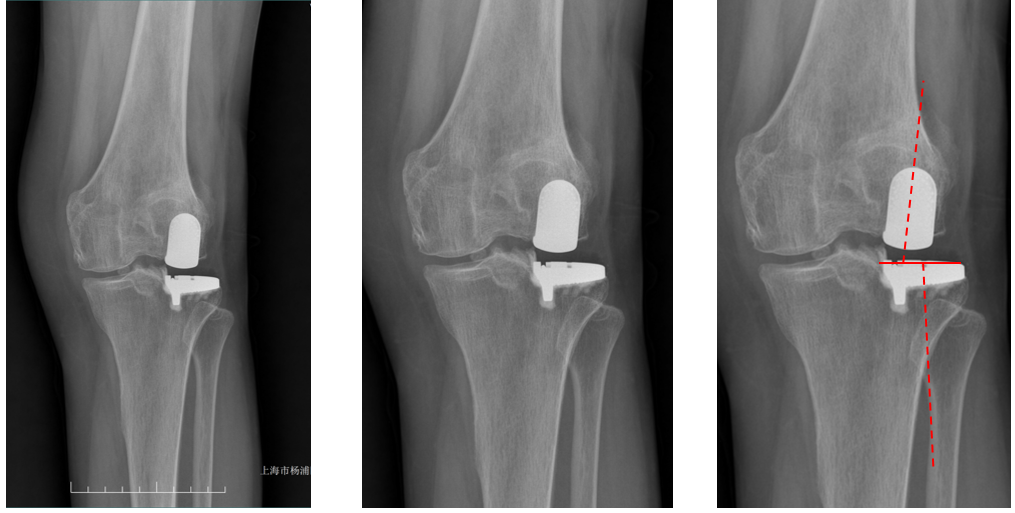 【读懂单髁】从读懂X-ray开始：固定平台单髁假体(LINK®