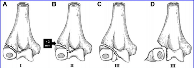 儿童肱骨外髁骨折的诊疗，本文全面总结！