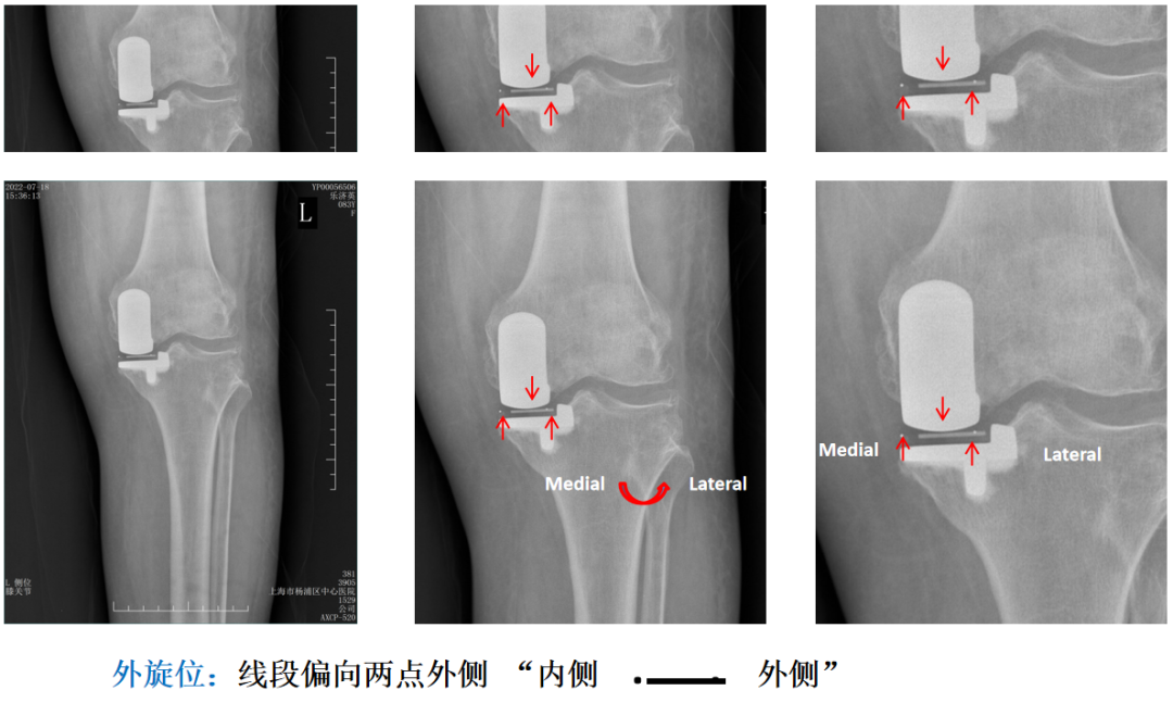 【读懂单髁】从读懂X-ray开始：术后摄片技术及垫片位置解读