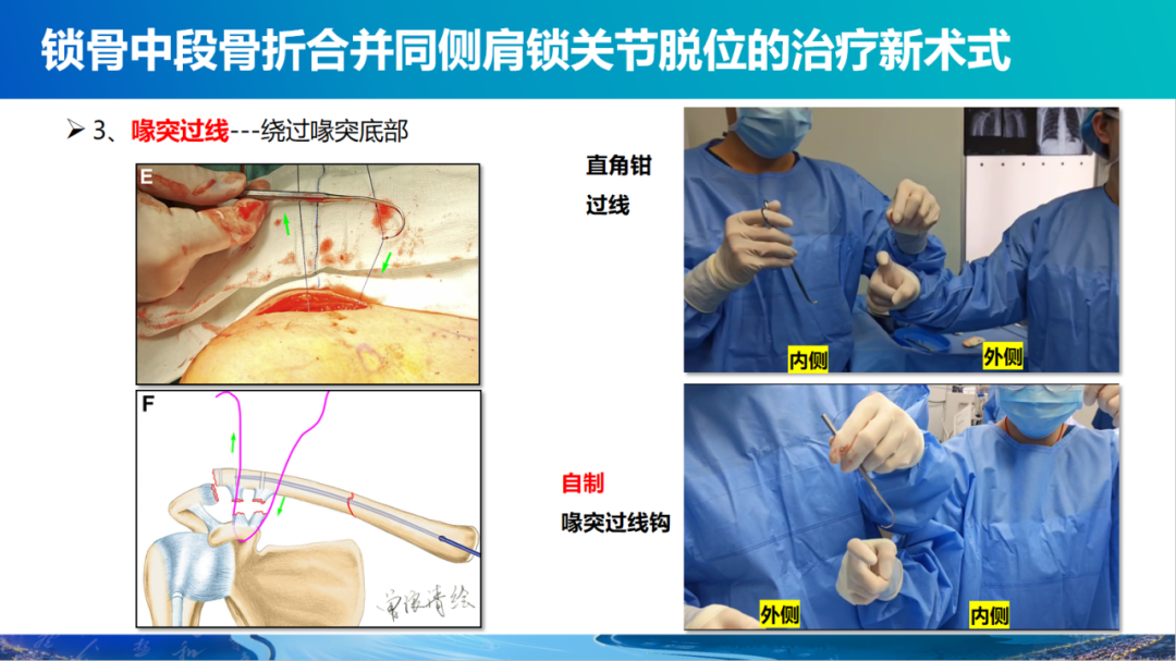 锁骨中段骨折合并同侧肩锁关节脱位新术式：弹性髓内钉+喙锁韧带重建、关节囊缝合