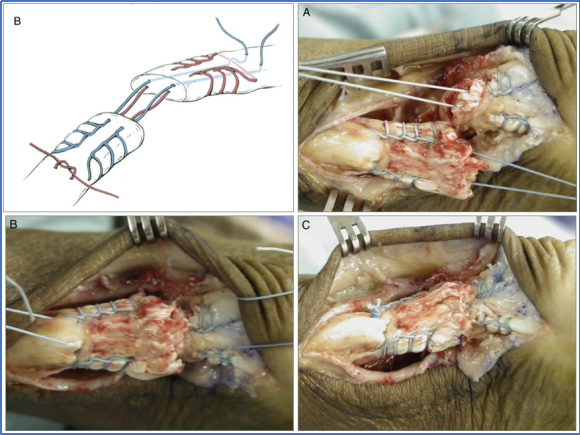【手术技术】切开修复技术治疗急性跟腱断裂
