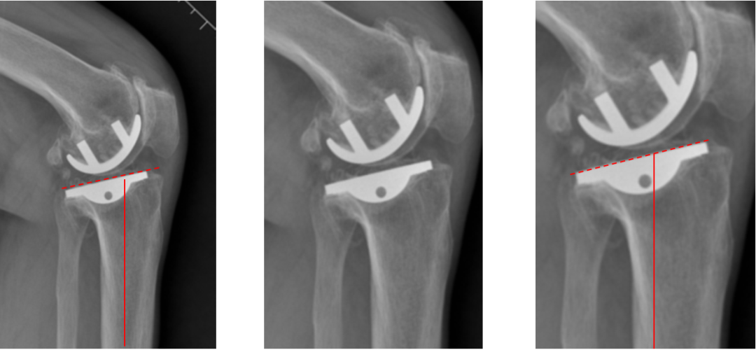 【读懂单髁】从读懂X-ray开始：固定平台单髁假体(LINK®