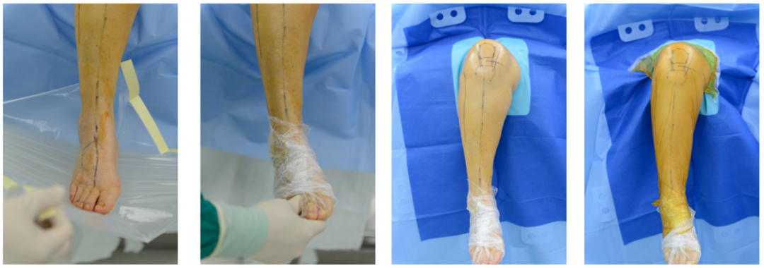 【滑动垫片单髁置换技术精讲系列】第一讲：麻醉、体位