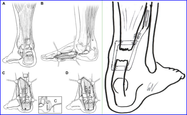 ​图文并茂：慢性跟腱断裂的最新治疗进展