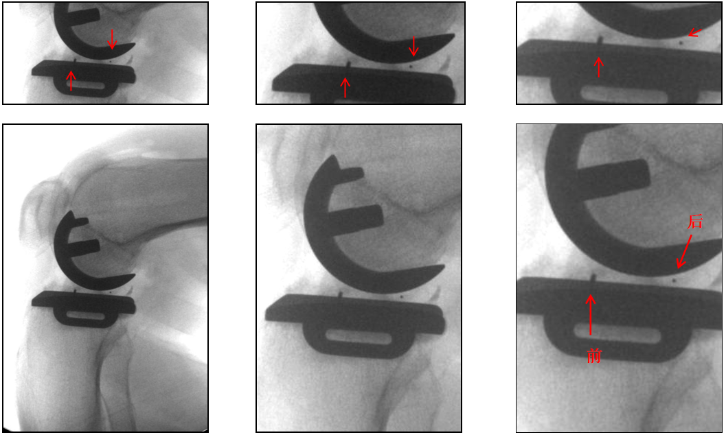 【读懂单髁】从读懂X-ray开始：术后摄片技术及垫片位置解读
