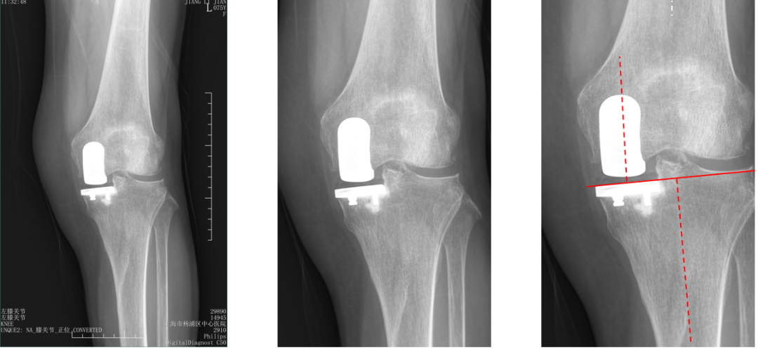 【读懂单髁】从读懂X-ray开始：固定平台单髁假体(SIGMA®