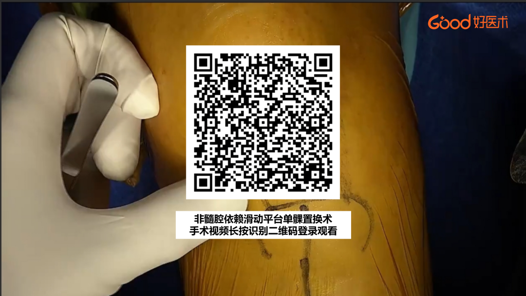 【手术视频】第二期：非髓腔依赖滑动平台单髁置换术
