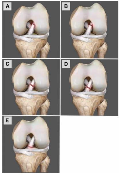 图文详解关节镜下如何实现对前交叉韧带近端撕裂的精准修复