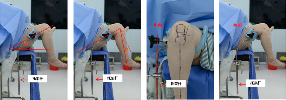 【滑动垫片单髁置换技术精讲系列】第一讲：麻醉、体位