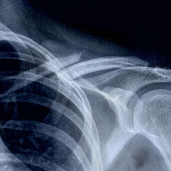 锁骨骨折：从分型到治疗的超全讲解，一文搞定！