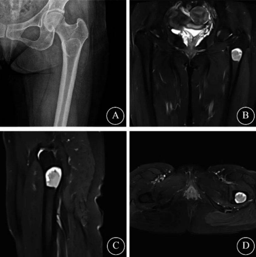 关节镜辅助单孔非同轴内镜手术治疗的前世今生