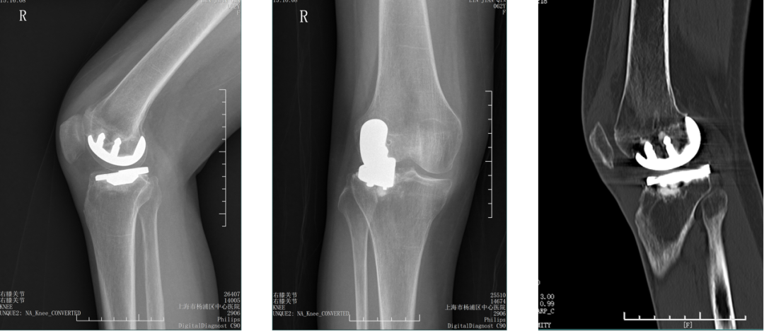 【读懂单髁】从读懂X-ray开始：固定平台单髁假体(SIGMA®