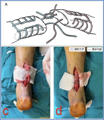 【手术技术】切开修复技术治疗急性跟腱断裂