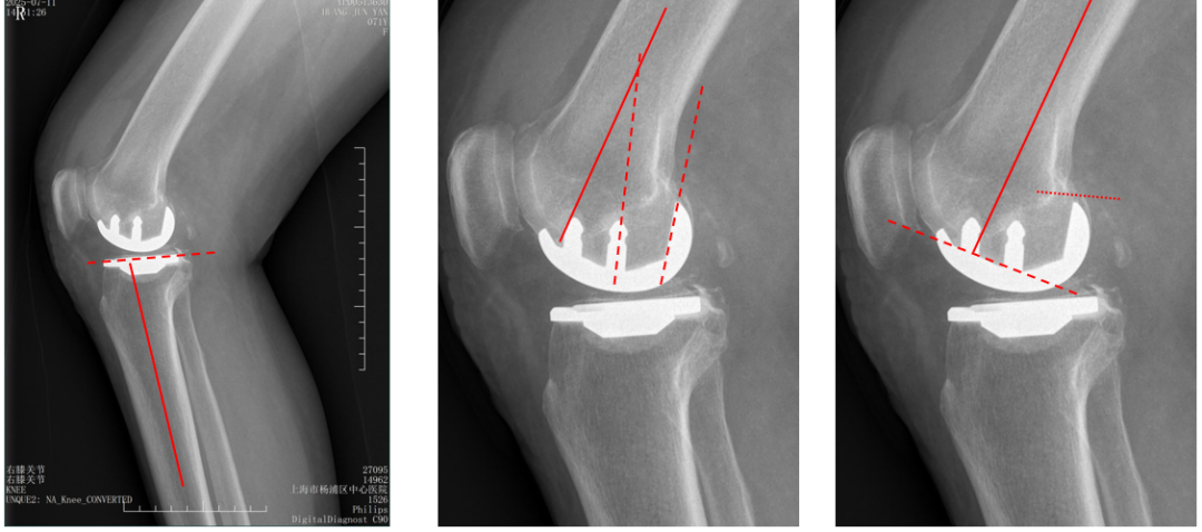 【读懂单髁】从读懂X-ray开始：固定平台单髁假体(SIGMA®