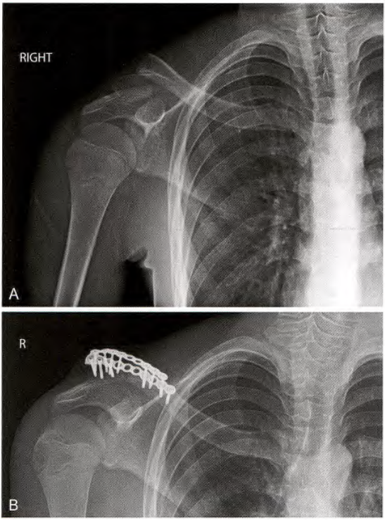 锁骨骨折：从分型到治疗的超全讲解，一文搞定！