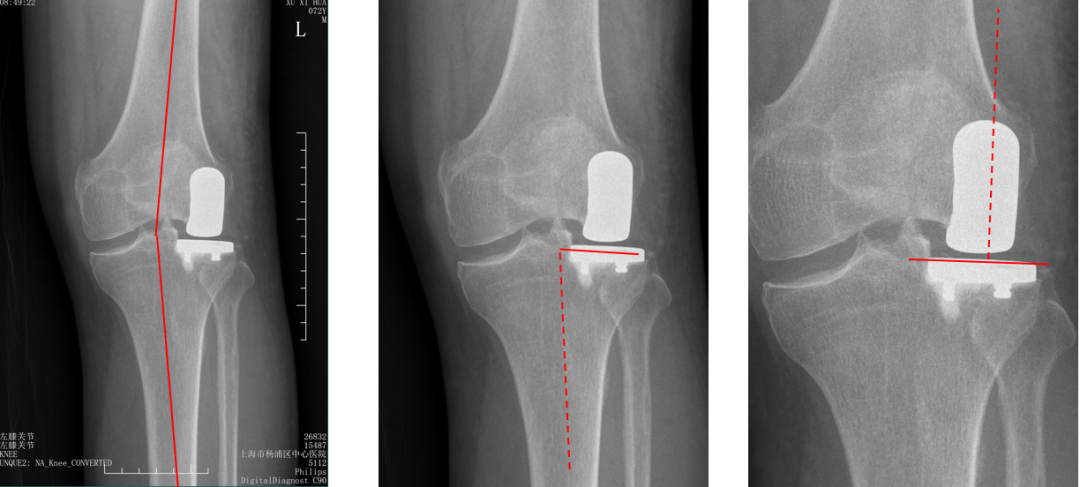 【读懂单髁】从读懂X-ray开始：固定平台单髁假体(SIGMA®