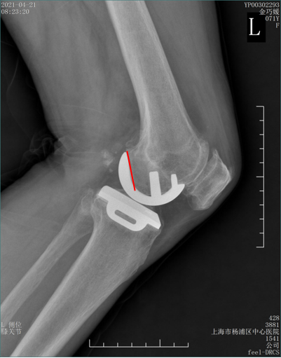 【读懂单髁】从读懂X-ray开始：术后摄片技术及垫片位置解读