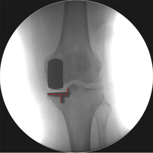 【读懂单髁】从读懂X-ray开始：术后摄片技术及垫片位置解读