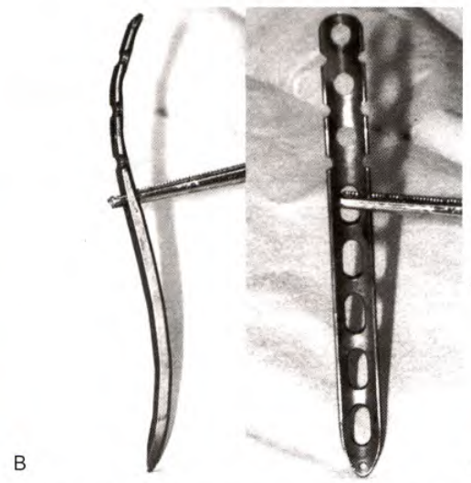 锁骨骨折：从分型到治疗的超全讲解，一文搞定！