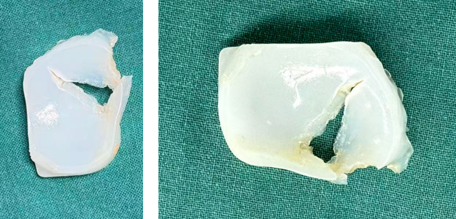 【读懂单髁】从读懂X-ray开始：术后摄片技术及垫片位置解读