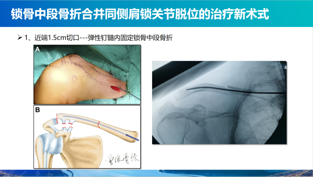 锁骨中段骨折合并同侧肩锁关节脱位新术式：弹性髓内钉+喙锁韧带重建、关节囊缝合