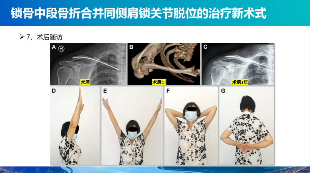 锁骨中段骨折合并同侧肩锁关节脱位新术式：弹性髓内钉+喙锁韧带重建、关节囊缝合