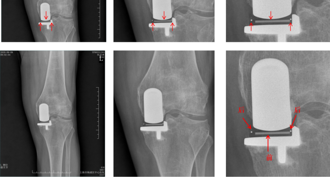 【读懂单髁】从读懂X-ray开始：术后摄片技术及垫片位置解读