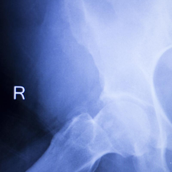 锁骨骨折：从分型到治疗的超全讲解，一文搞定！