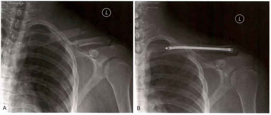 锁骨骨折：从分型到治疗的超全讲解，一文搞定！