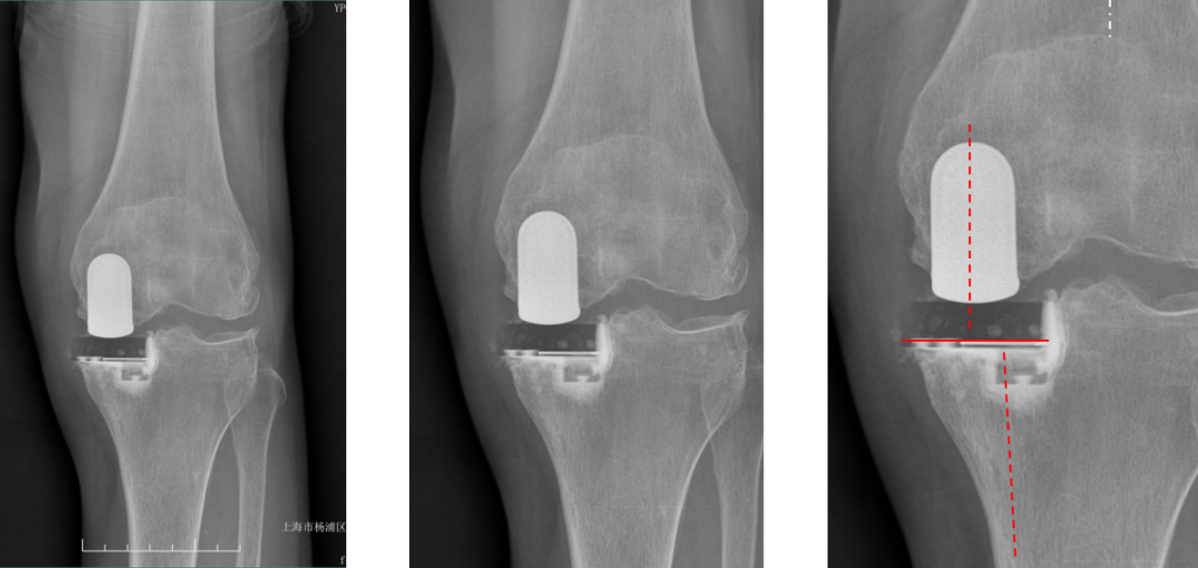 【读懂单髁】从读懂X-ray开始：固定平台单髁假体(LINK®